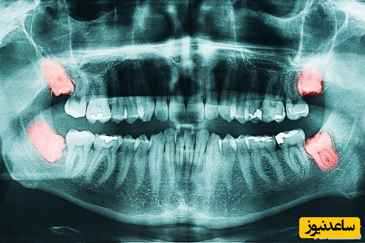 انواع عصب کشی در کودکان