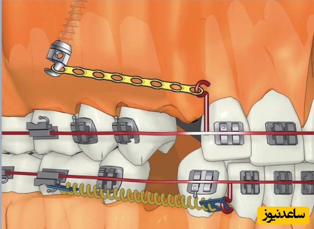 مینی اسکرو چیست؟