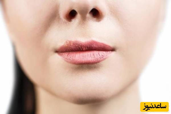 3 دقیقه ای تبخال را نابود کنید