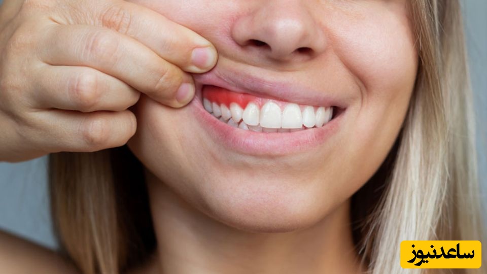 مراقبت های بعد از جراحی لثه چیست؟