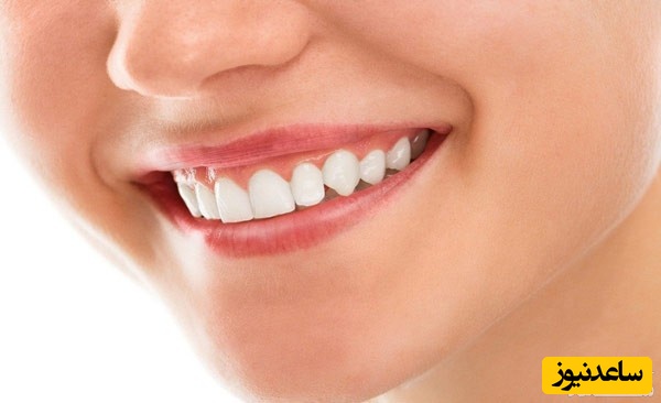 روشهای درمان لبخند لثه ای (با جراحی و بدون جراحی)