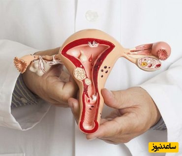 کاندیدیازیس واژنینال چیست و چه علائمی دارد؟