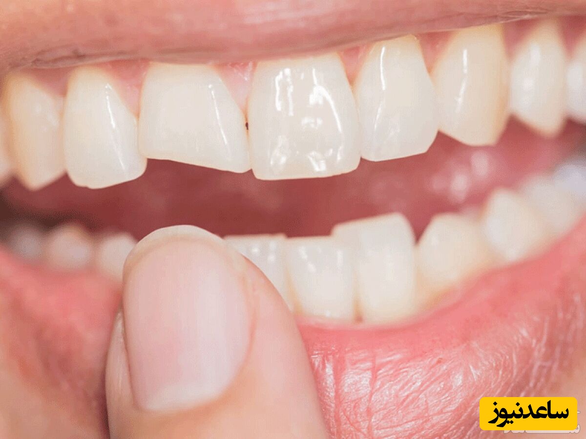 لمینیت دندان خرگوشی چیست؟