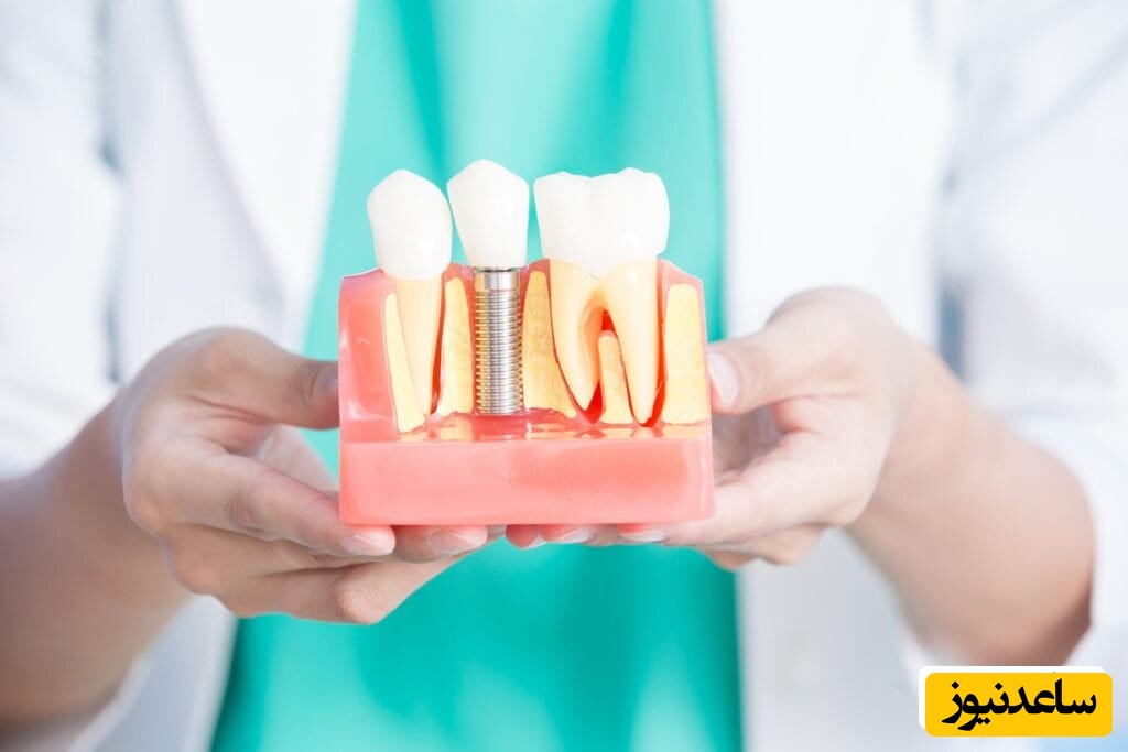 ایمپلنت یک روزه چیست؟