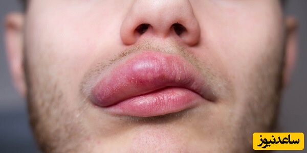 علل ورم ناگهانی لب، تشخیص و راه‌های درمان مؤثر
