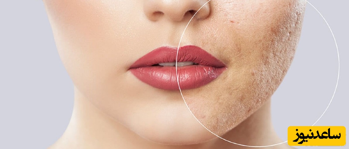 چند راهکار ساده برای رفع سلول های مرده پوست صورت که باید بدانید