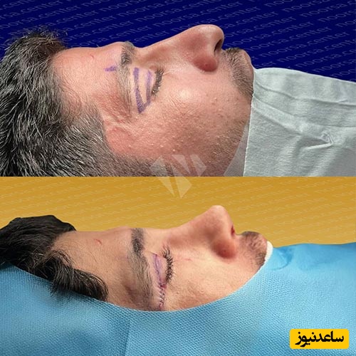 قبل و بعد از جراحی بینی استخوانی