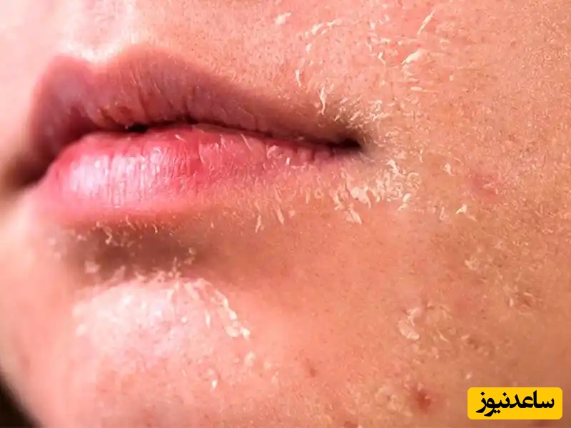 بهترین روش درمان خشکی پوست صورت و بدن بدون داشتن عوارض چیست؟