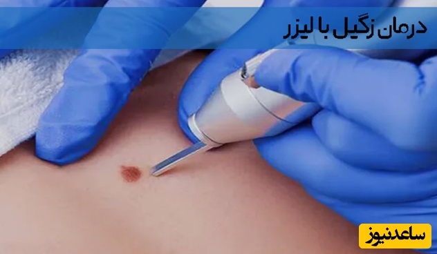 درمان زگیل تناسلی با لیزر در تهران