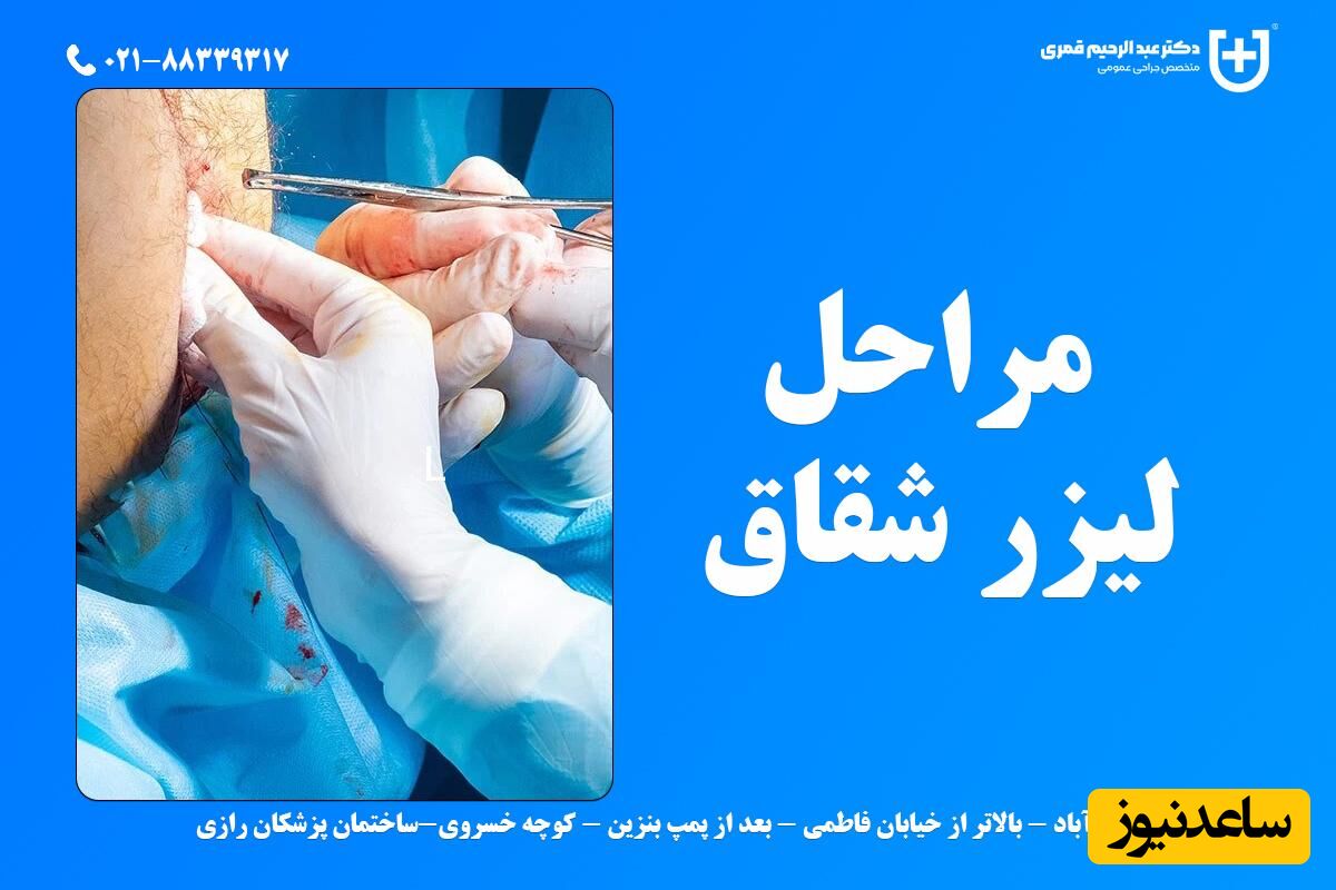 مراحل عمل شقاق با لیزر