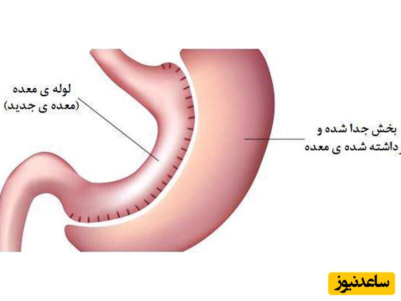 بای پس بهتر است یا اسلیو معده؟