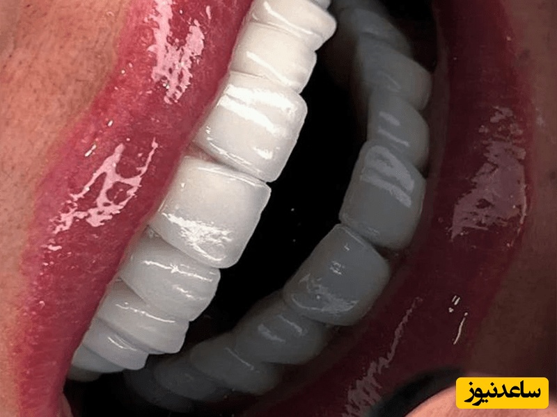 کامپوزیت دندان چگونه توسط دندان پزشک انجام میشود؟