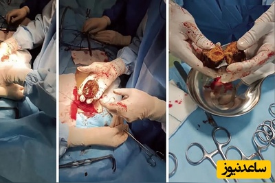 هشدار جدی برای شب یلدا؛ مصرف این میوه‌ها باهم شما را به تخت جراحی می‌کشد + فیلم