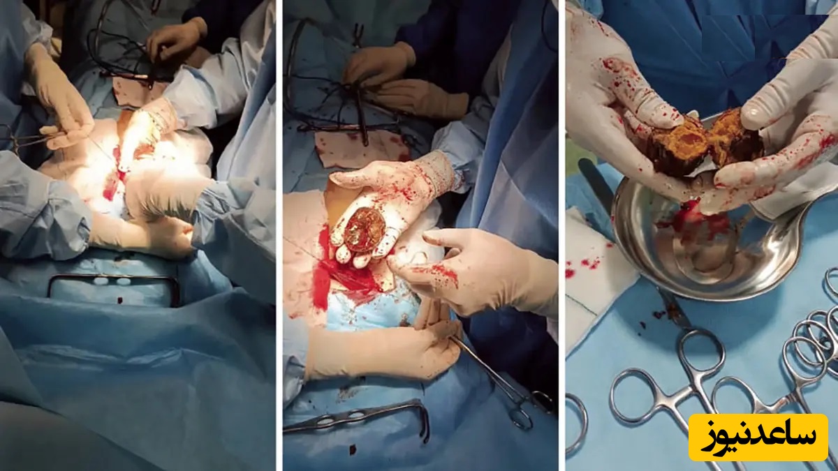 هشدار جدی برای شب یلدا؛ مصرف این میوه‌ها باهم شما را به تخت جراحی می‌کشد + فیلم