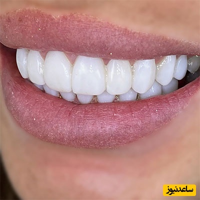 درمان زگیل دهانی