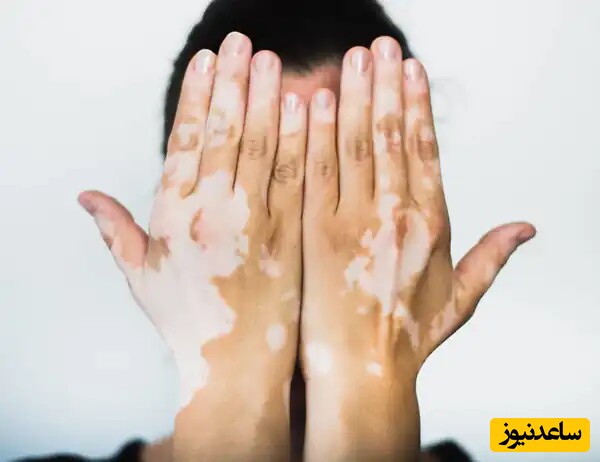 دیدن پیسی (لکه روی بدن) در خواب چه تعبیری دارد؟ / تعبیر خواب پیسی