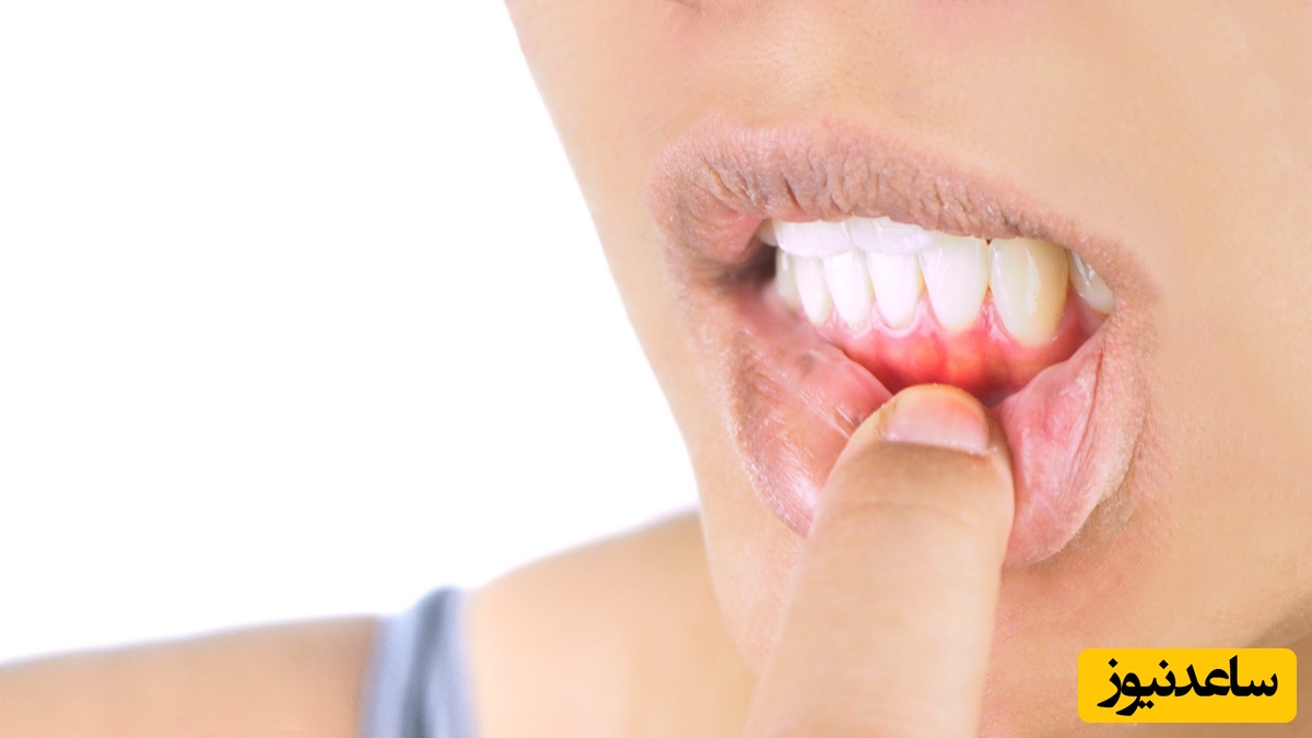 درمان سندروم التهاب دهان به روش پزشکی
