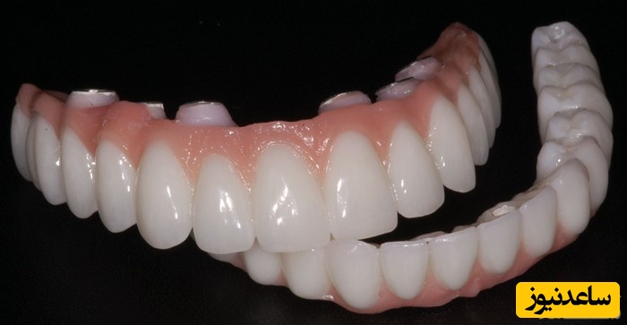 تفاوت ها و شباهت های ایمپلنت دندان ثابت، اوردنچر و دندان مصنوعی متحرک