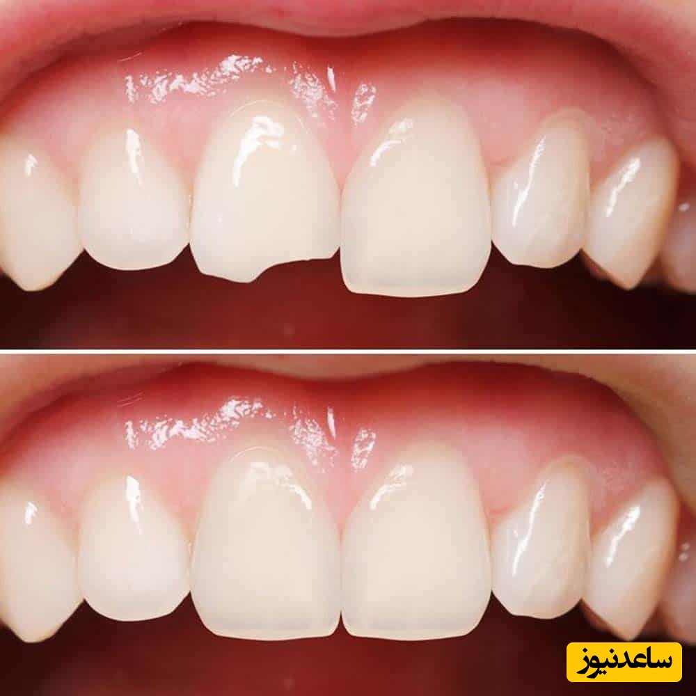 اقدامات اولیه به هنگام آسیب‌ها و شکستگی‌ دندان چیست؟