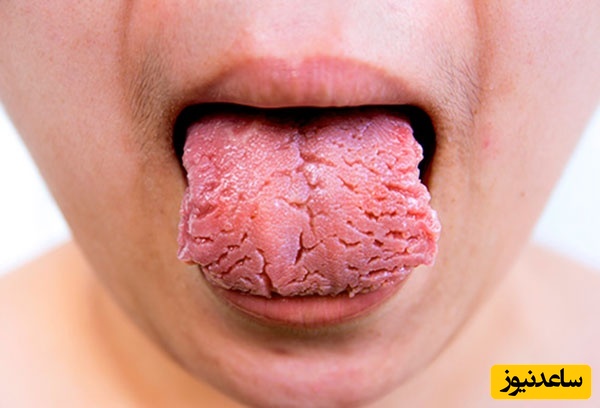 علت بریده بریده شدن زبان؛ دلایل، علائم و روش‌های درمان