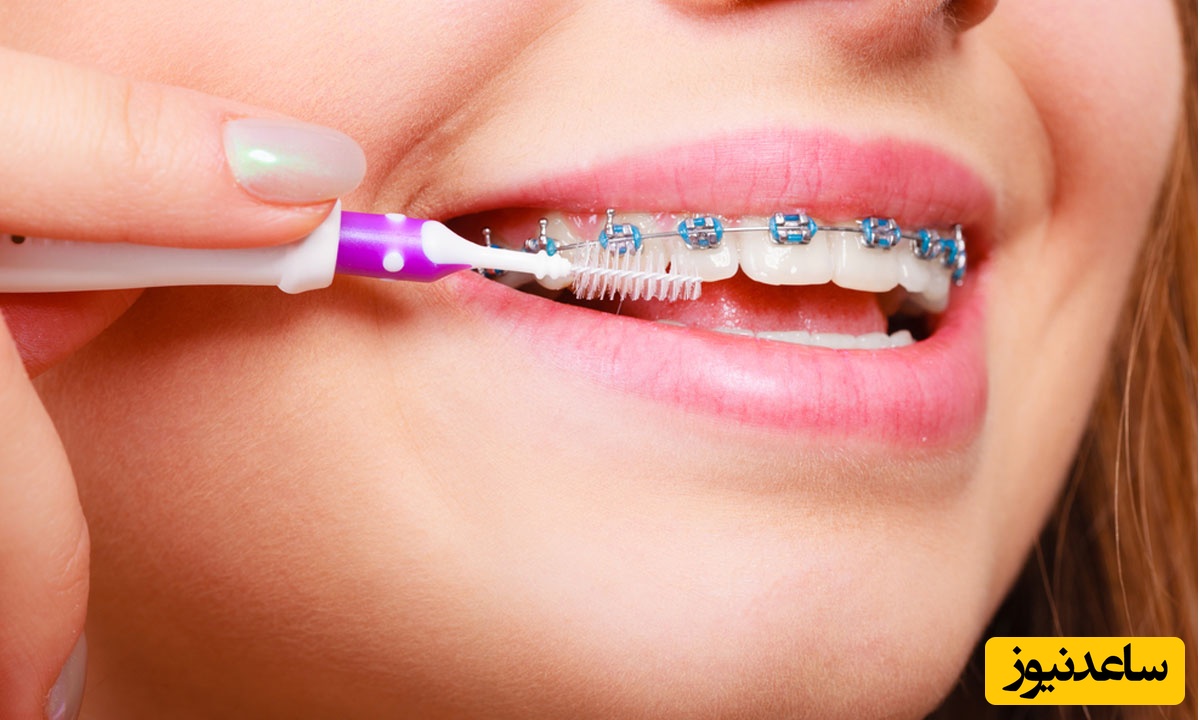 یک مسواک خوب ارتودنسی چه مشخصاتی دارد؟