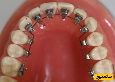 در مورد ارتودنسی لینگوال چه میدانید؟