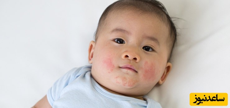 علت کهیر زدن نوزاد و روش‌های درمان آن چیست؟