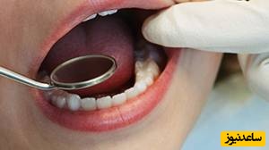 دلایل خونریزی دندان کودک چیست؟