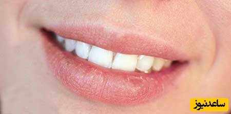 زخم گوشه‌ای لب چیست؟