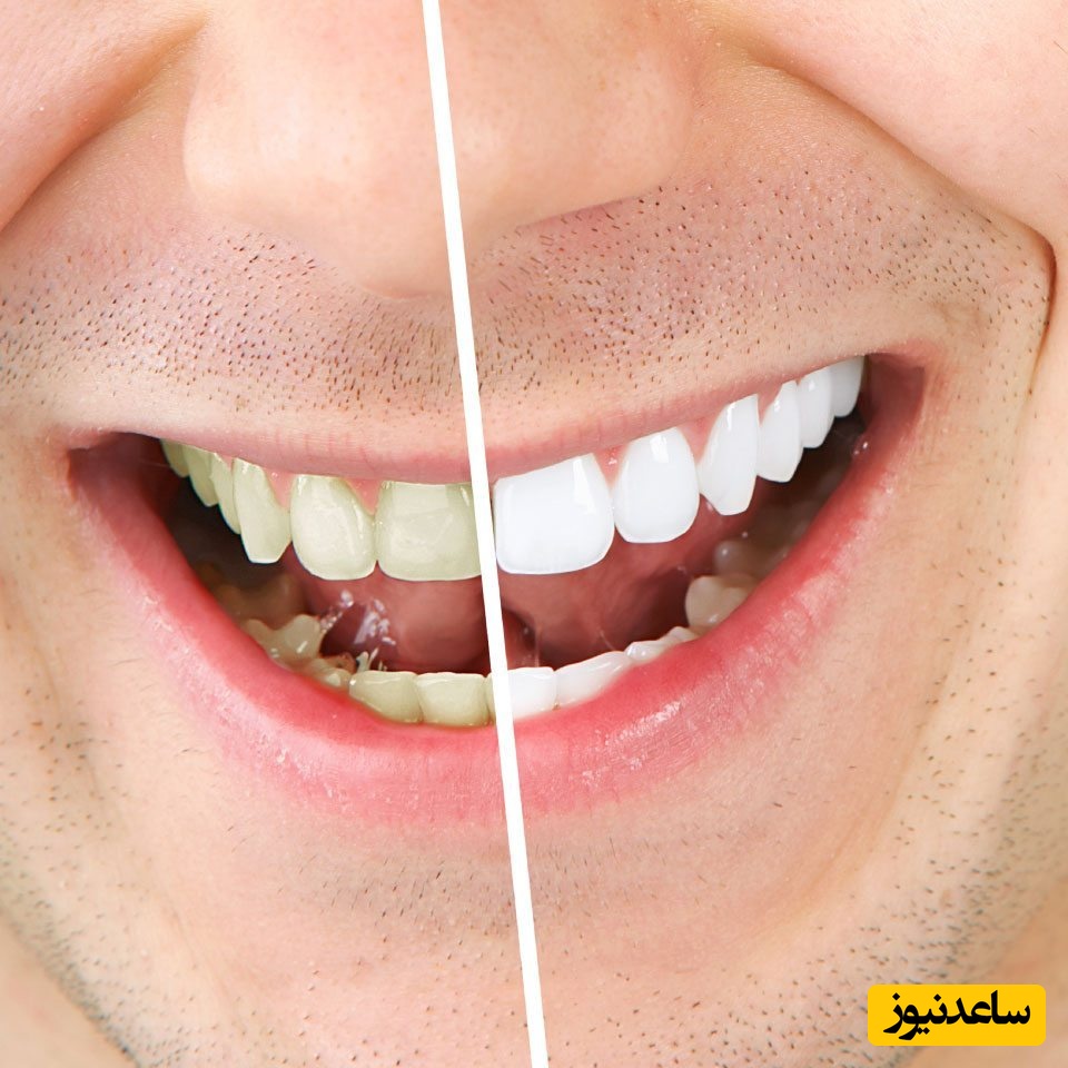 سفیدی دندان در کمتر از پنج دقیقه