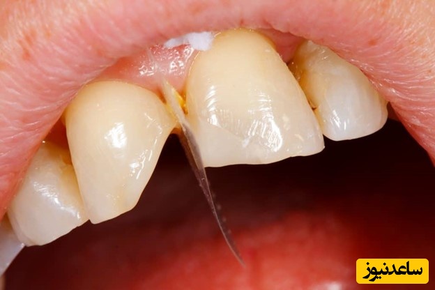 دندان ترک خورده و انواع آن