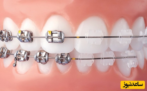چرا ارتودنسی نامرئی  برای دانشجویان بهتر است؟