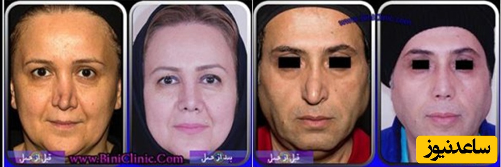 عمل جراحی بینی