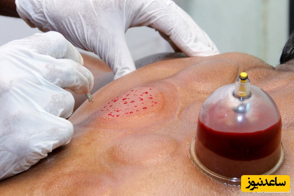 دیدن حجامت در خواب چه تعبیری دارد؟/ تعبیر خواب حجامت