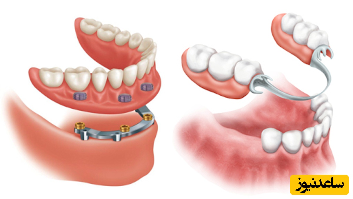 پروتز دندان متحرک بر چند نوع است؟