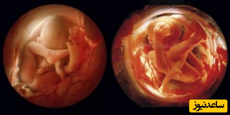 جفت خلفی و زایمان؛ چه چیزهایی را مادر باید بداند