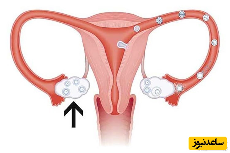 با دلایل و علائم افتادگی رحم در زنان بیشتر آشنا شوید!