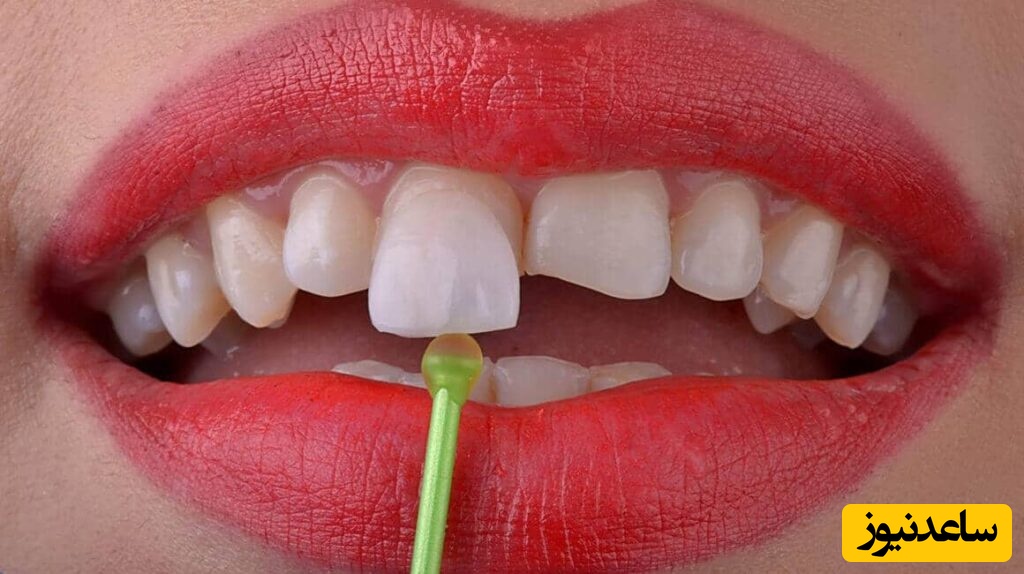 لومینیرز دندان چیست؟