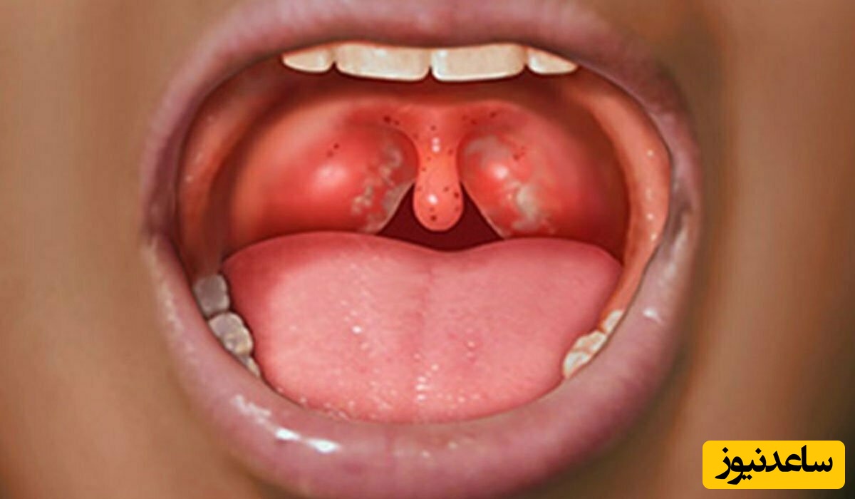 تکه های سفید ته گلو چیست؟