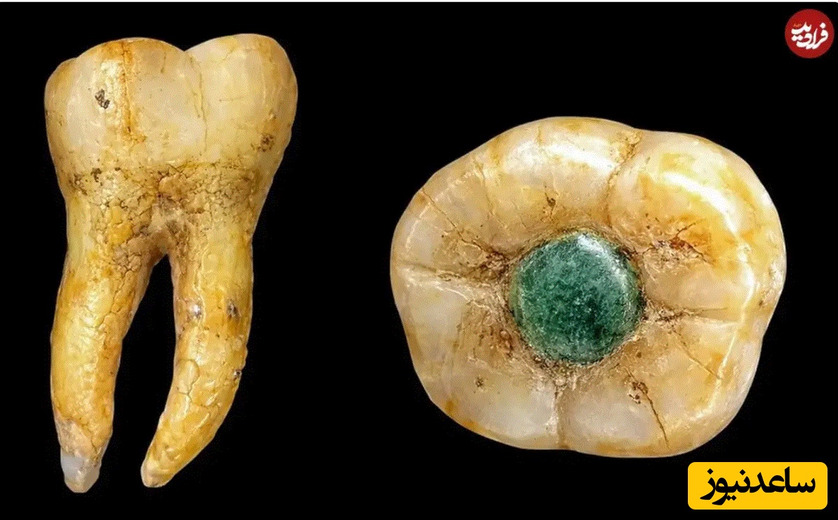 دندان جواهر نشان