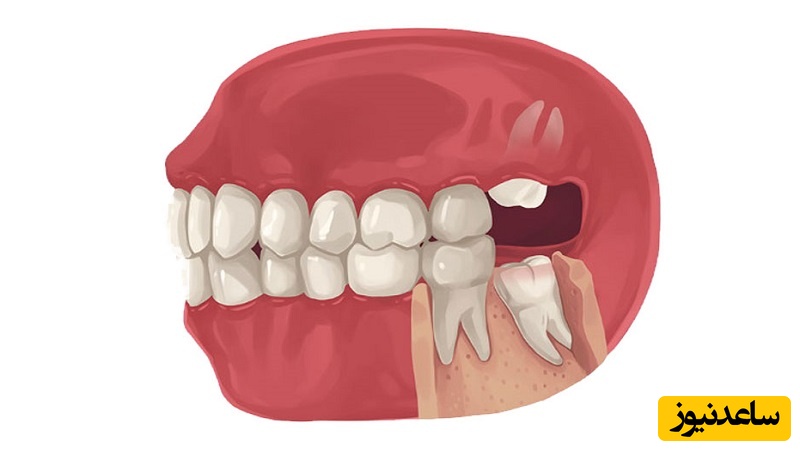 کشیدن دندان عقل الزامی است؟