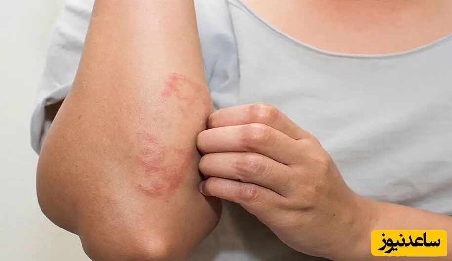 علل و علائم کهیرهای بعد از زایمان و روش های درمان