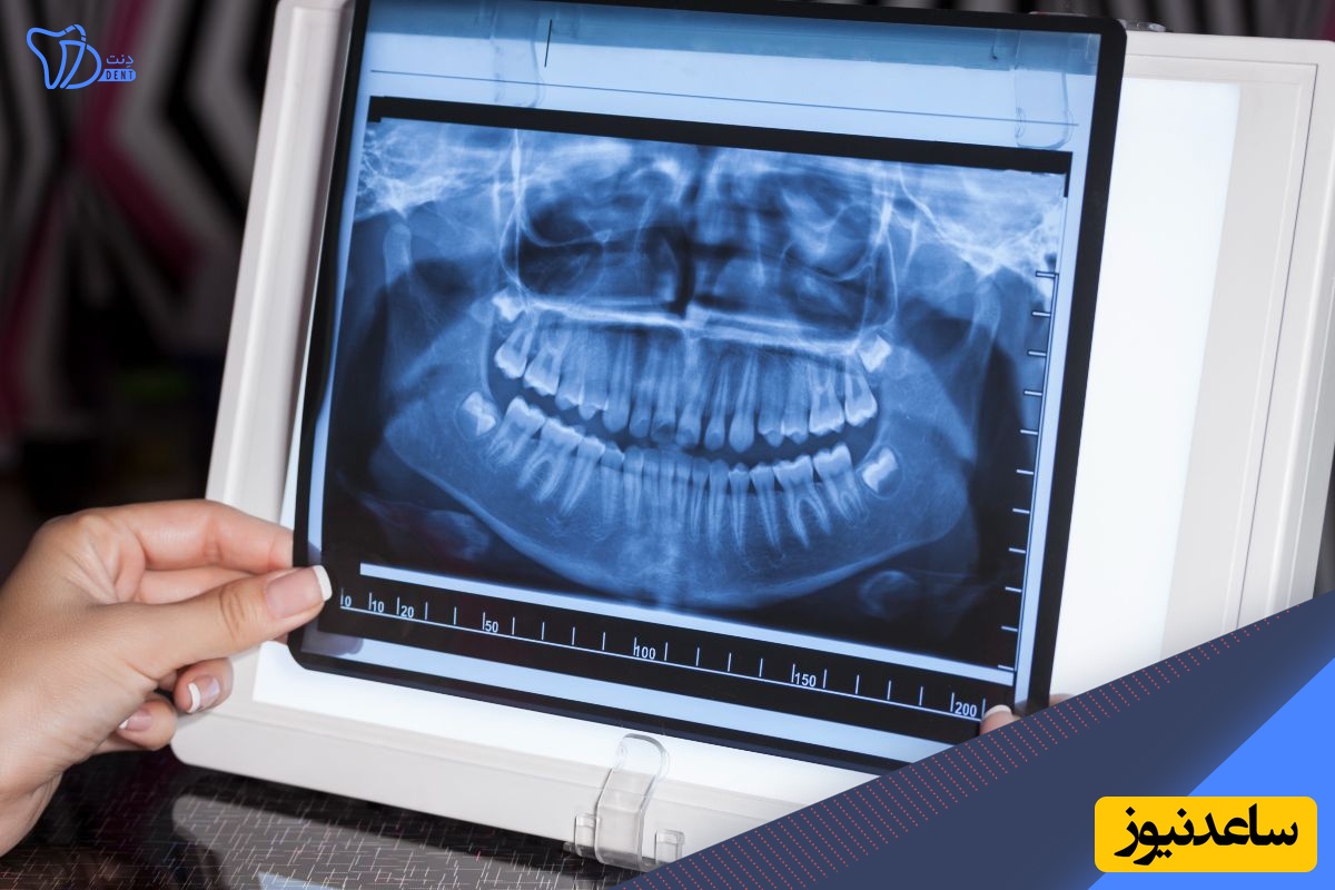 رادیوگرافی دندان چیست و انواع آن