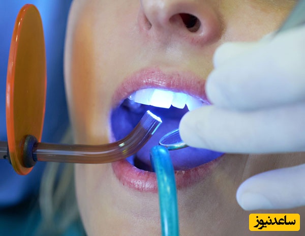 برای بهبود ظاهر دندان ها از کدام نوع لمینت استفاده کنیم؟