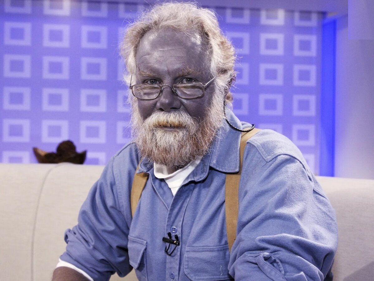 مرد آمریکایی با خوردن نقره رنگ پوستش را آبی کرد! + تصویر