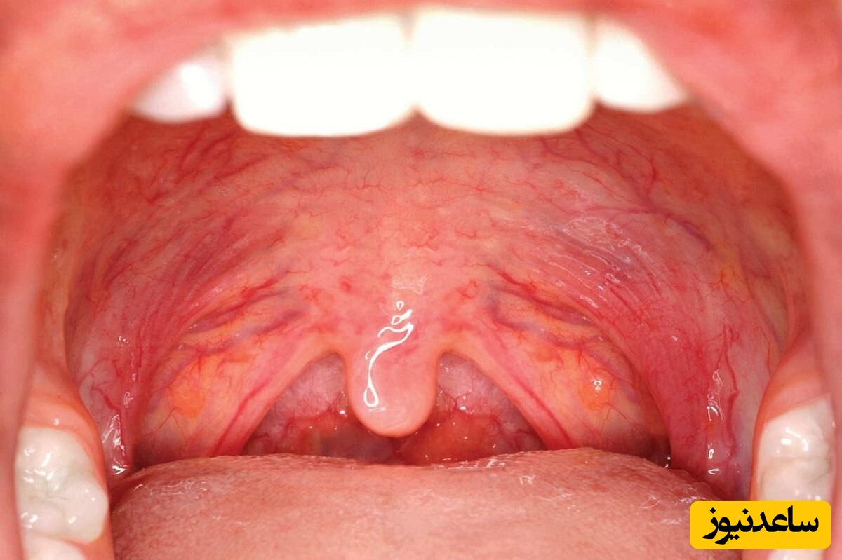 10 درمان خانگی موثر برای تورم زبان کوچک (اوولیت) + نکات کلیدی