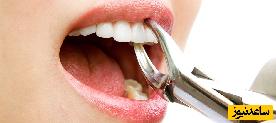 فرایند کشیدن دندان چگونه است؟