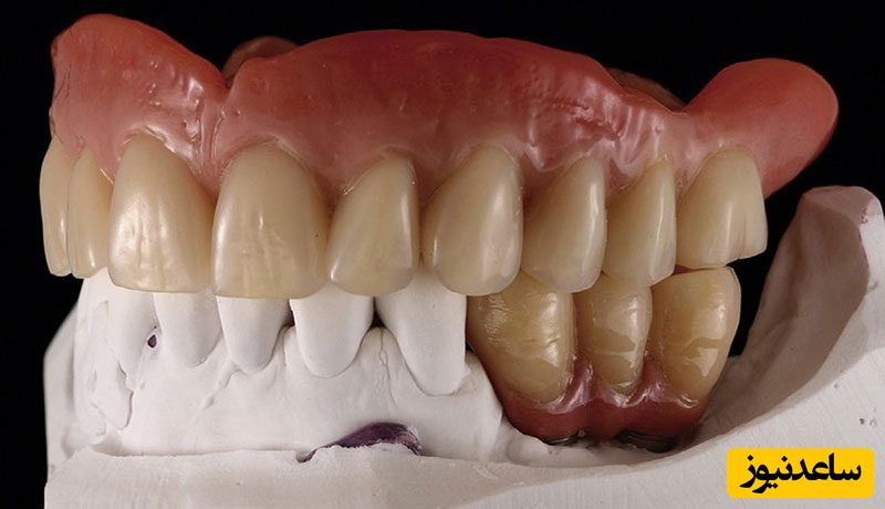 چرا اوردنچر برپایه ایمپلنت گاهی اوقات لازم می باشد؟