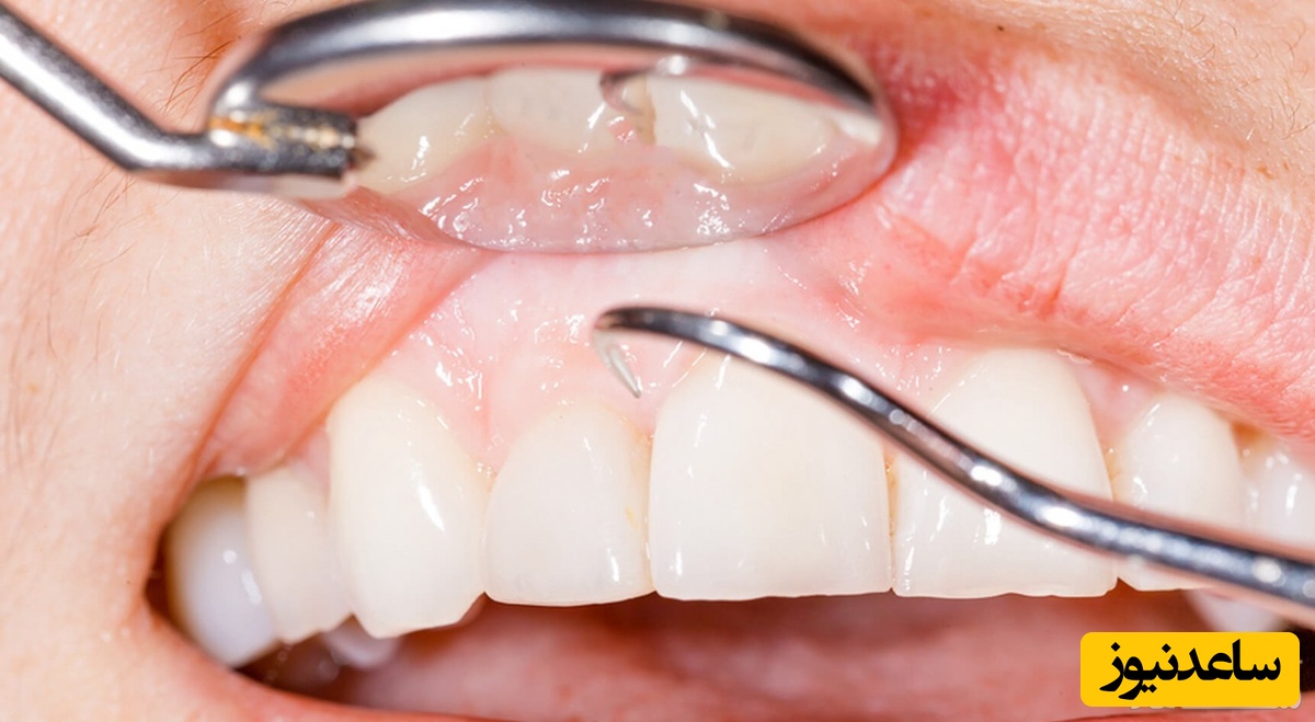 نکات مهم در مورد دندان های حساس