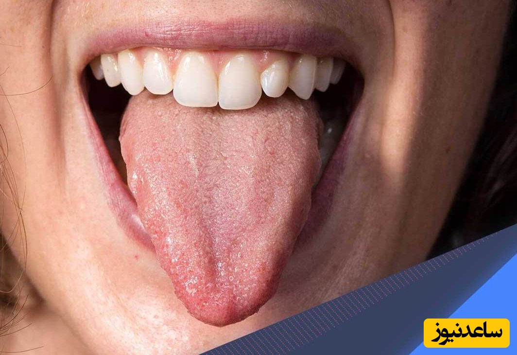 از کجا بفهمیم سندروم سوزش دهان داریم؟